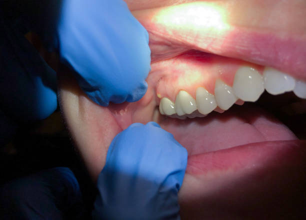Best Knocked-Out Tooth (Avulsed Tooth) Treatment in Wyanet, IL