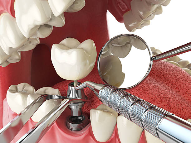 Best Knocked-Out Tooth (Avulsed Tooth) Treatment in Wyanet, IL